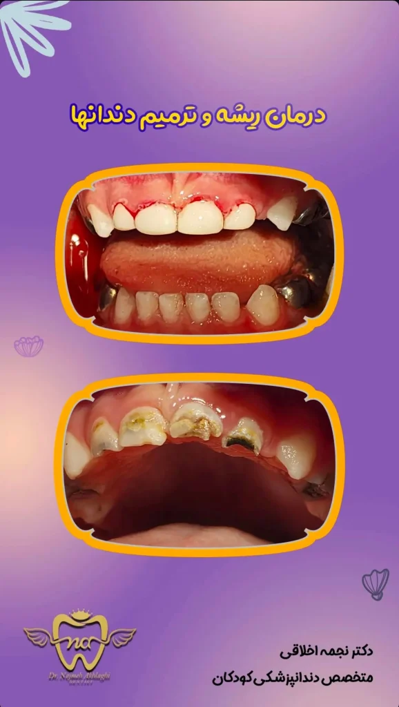 نمونه های درمانی روکش و ترمیم دندان کودک با بیهوشی | دکتر نجمه اخلاقی