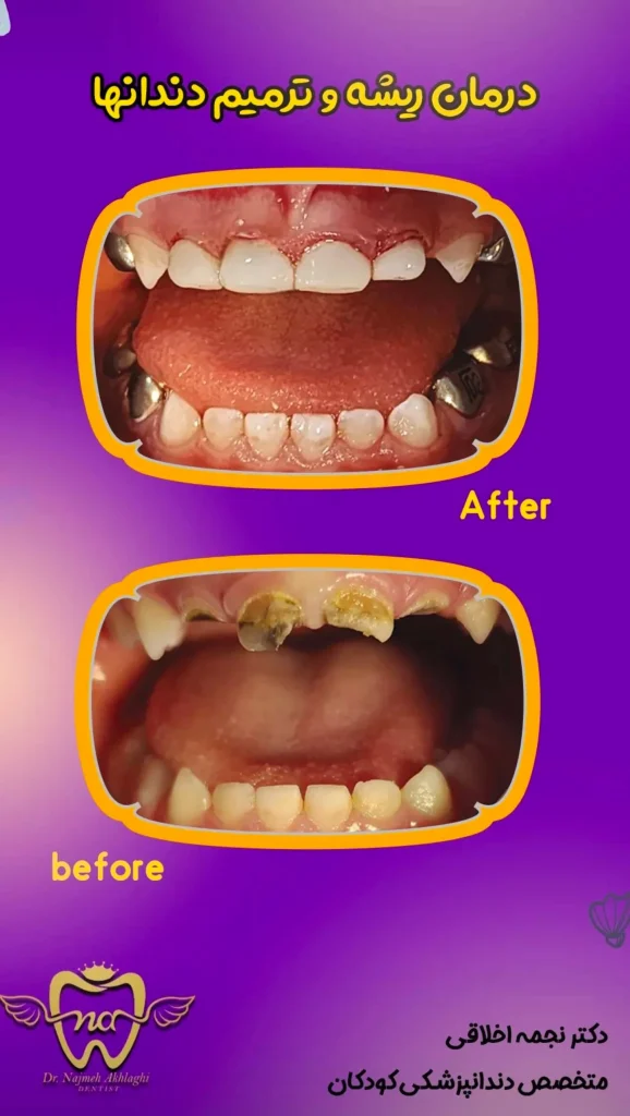 نمونه های درمانی روکش و ترمیم دندان کودک با بیهوشی | دکتر نجمه اخلاقی