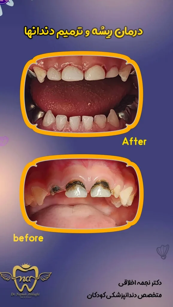 نمونه های درمانی روکش و ترمیم دندان کودک با بیهوشی در اصفهان| دکتر نجمه اخلاقی