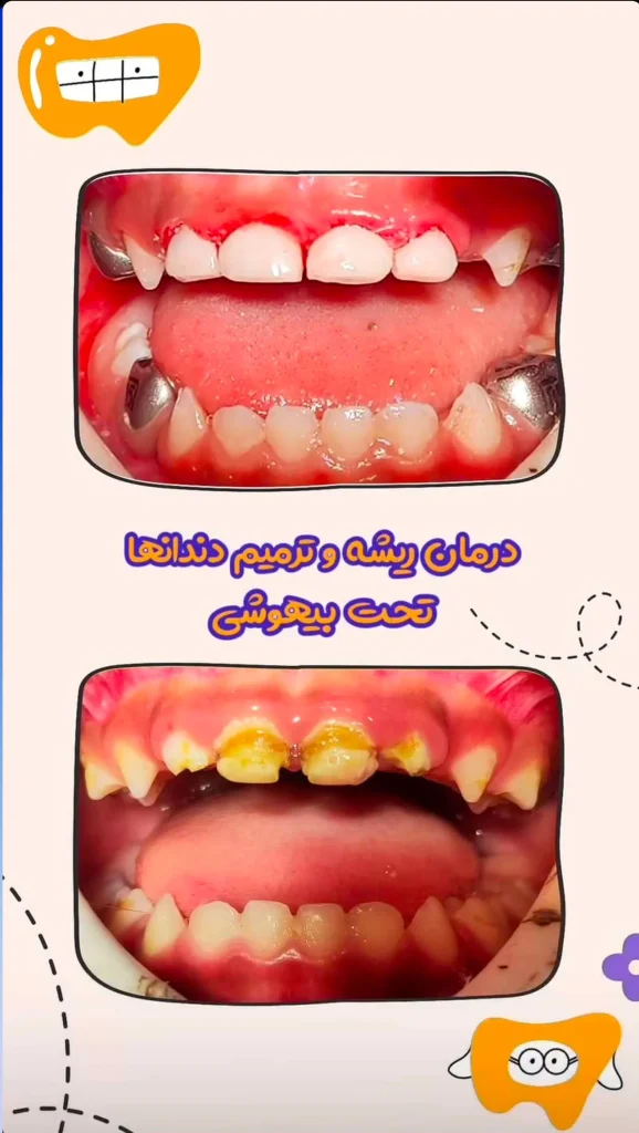 نمونه های درمانی روکش و ترمیم دندان کودک با بیهوشی | دکتر نجمه اخلاقی
