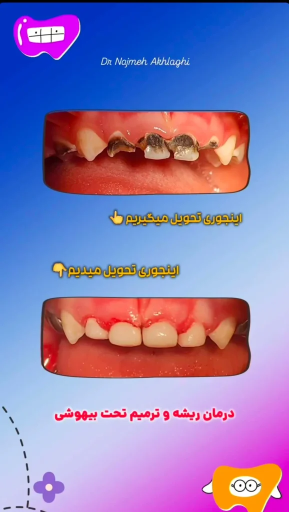 نمونه های درمانی روکش و ترمیم دندان کودک با بیهوشی | دکتر نجمه اخلاقی