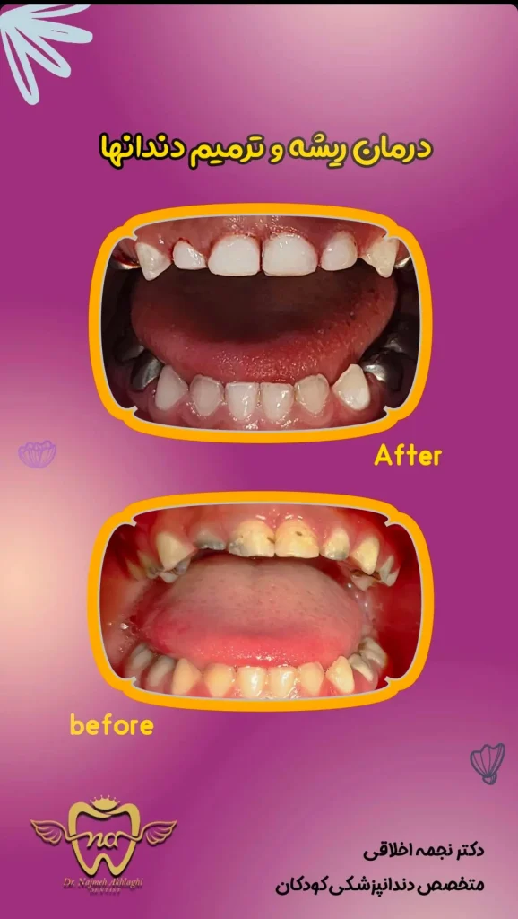 نمونه های درمانی روکش و ترمیم دندان کودک با بیهوشی | دکتر نجمه اخلاقی