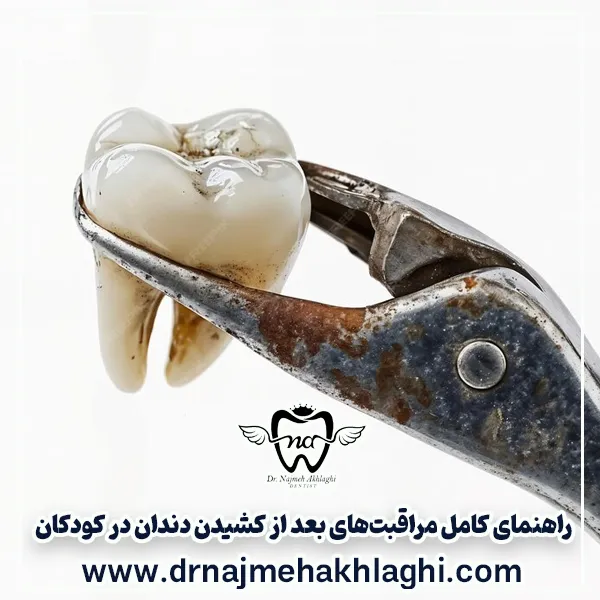 راهنمای کامل مراقبت‌های بعد از کشیدن دندان در کودکان