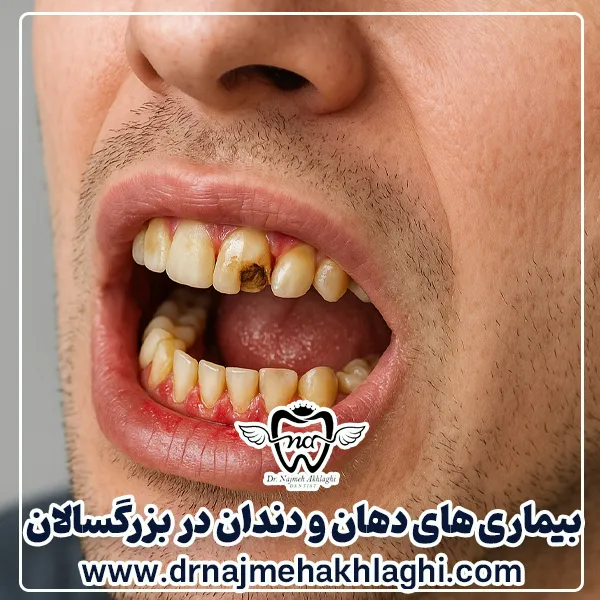 بیماری های دهان و دندان در بزرگسالان