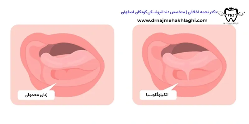 گره زبانی (انکیلوگلوسیا): وقتی زبان کودک "گره می‌خورد" و راه حل چیست؟