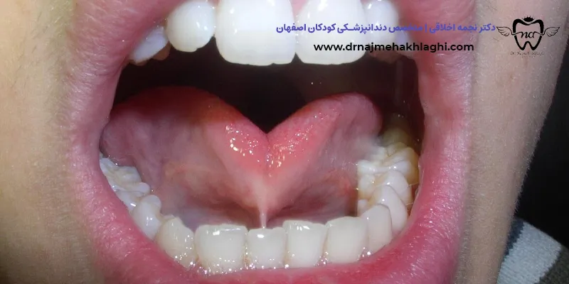 گره زبانی چیست؟ (Ankyloglossia)