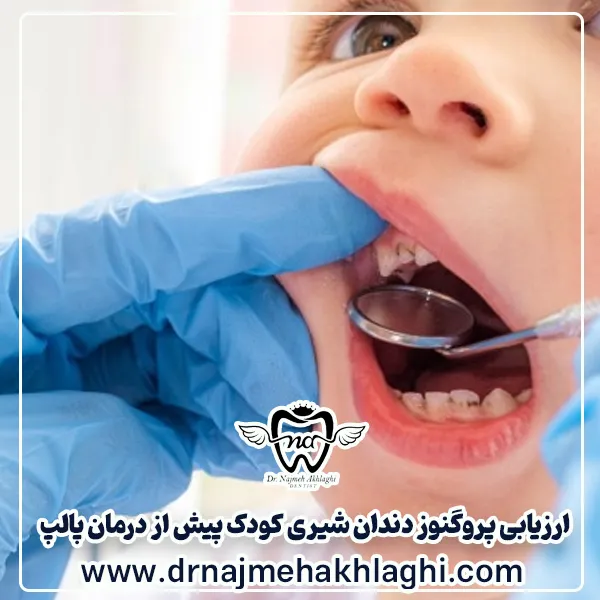 ارزیابی پروگنوز دندان شیری کودک پیش از درمان پالپ (عصب‌کشی)