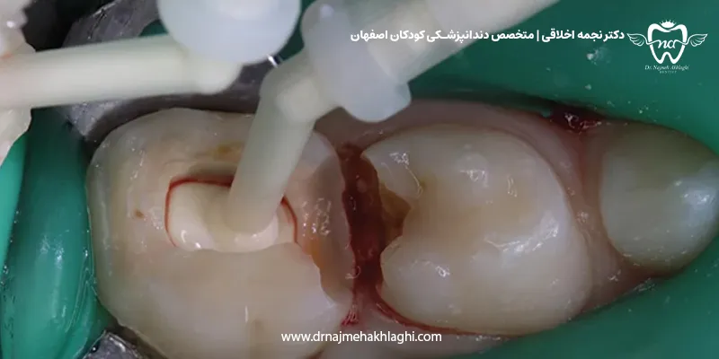 پالپکتومی دندان شیری کودکان چیست؟ مراحل، مزایا و تفاوت آن با پالپوتومی