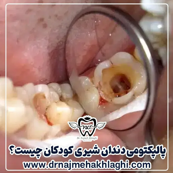 پالپکتومی دندان شیری کودکان چیست؟ مراحل، مزایا و تفاوت آن با پالپوتومی