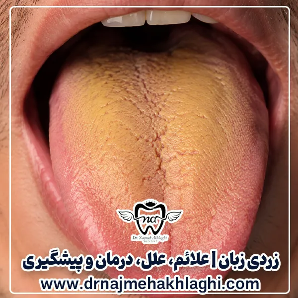 زردی زبان | علائم، علل، درمان و پیشگیری