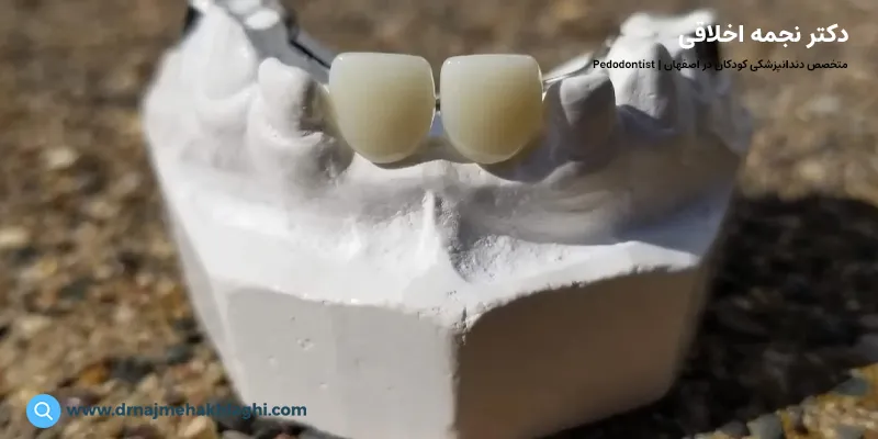 روکش بریج 
