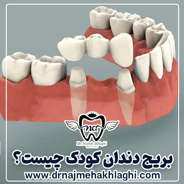 بریج دندان کودک