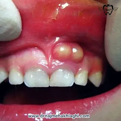 عکس آبسه لثه کودک