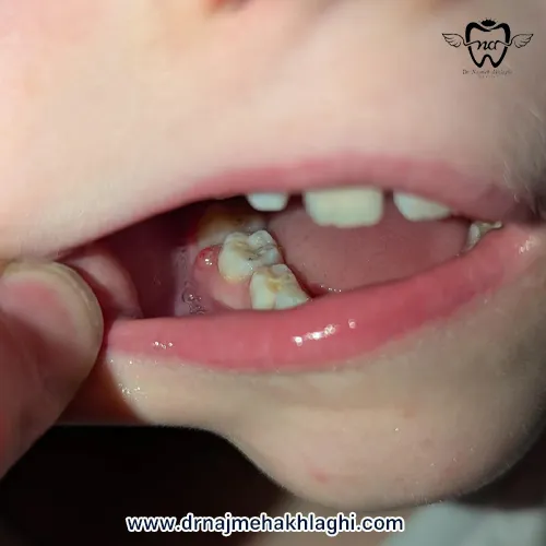 عکس آبسه لثه کودک