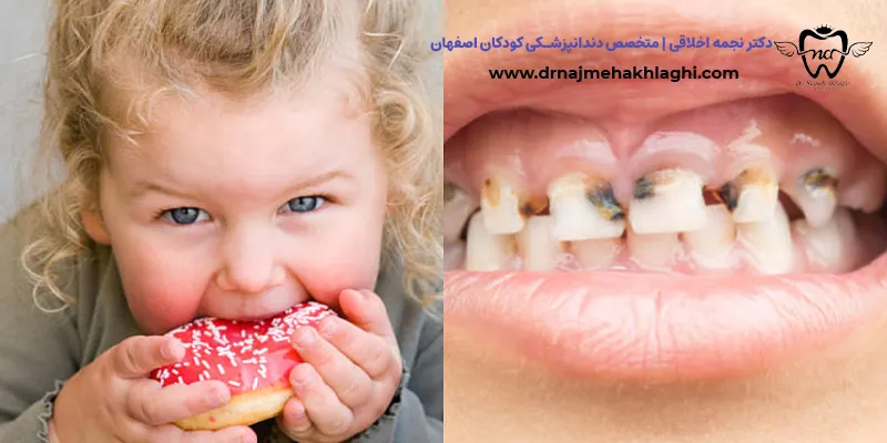 دلایل خرابی زودهنگام دندان های کودکان