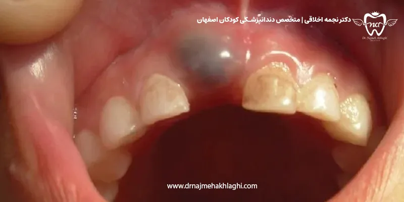کیست رویشی دندان شیری