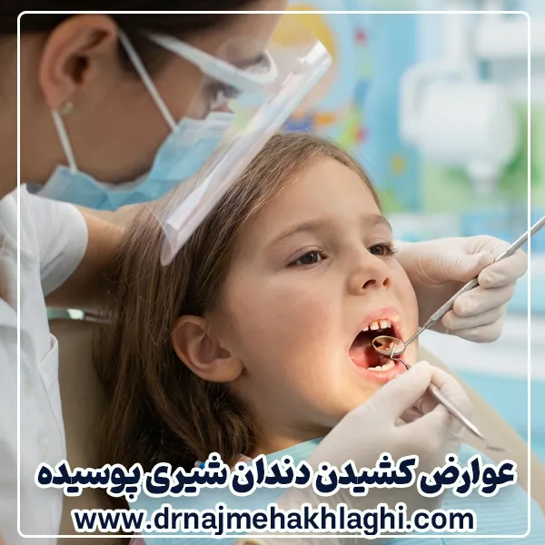 عوارض کشیدن دندان شیری پوسیده