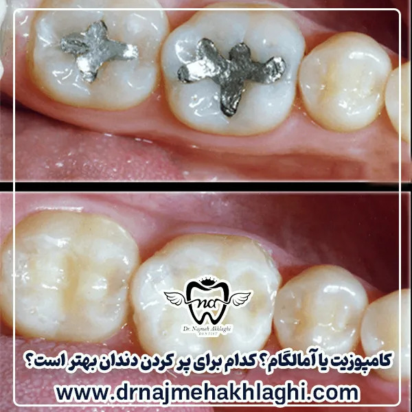 کامپوزیت یا آمالگام