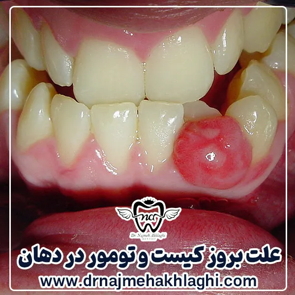 علت بروز کیست و تومور در دهان