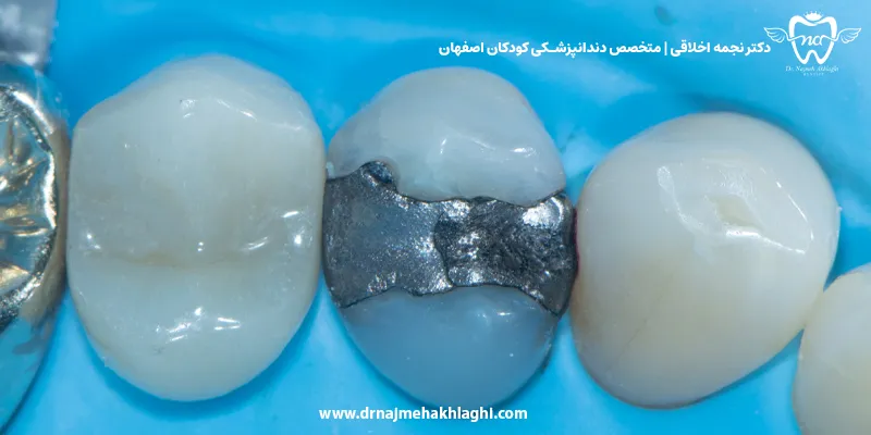 کف بندی دندان