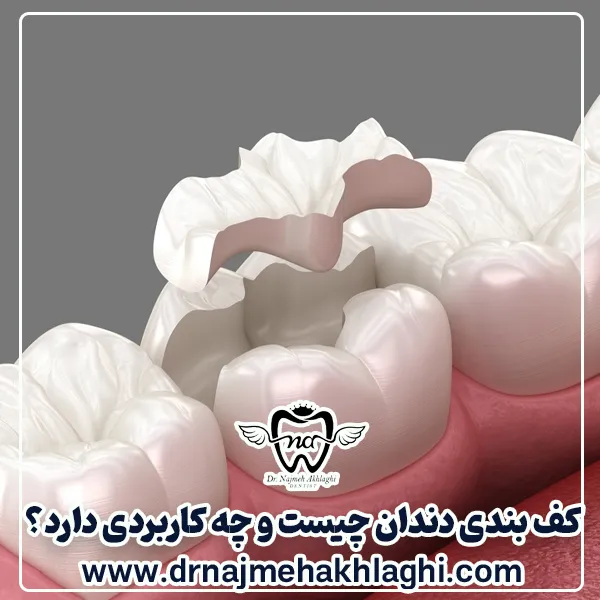 انواع کف بندی دندان