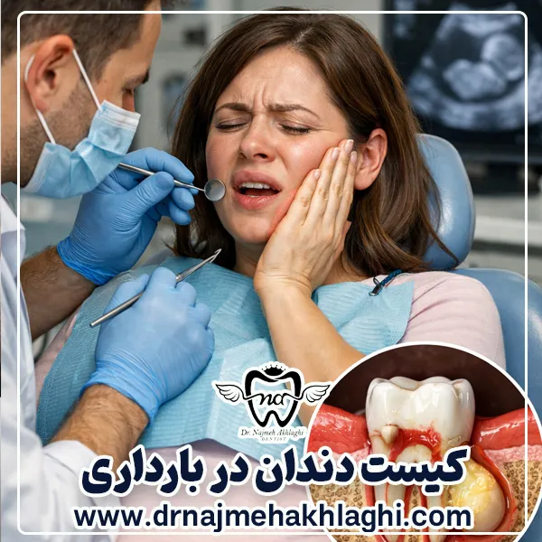 کیست دندان در بارداری