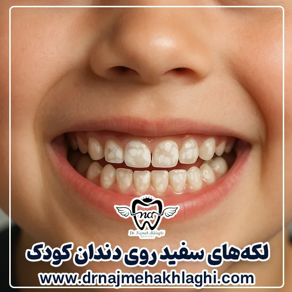 لکه های سفید روی دندان کودک
