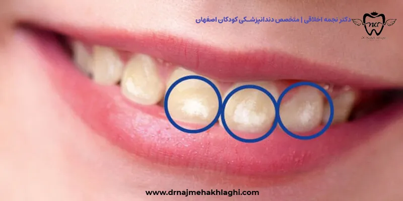لکه های سفید روی دندان کودک