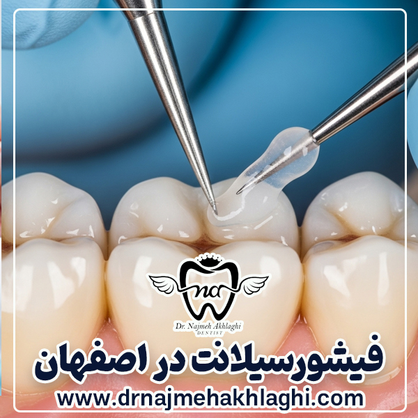 فیشورسیلانت در اصفهان