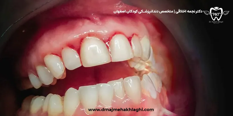 بیماری‌های لثه: ژنژیویت و پریودنتیت