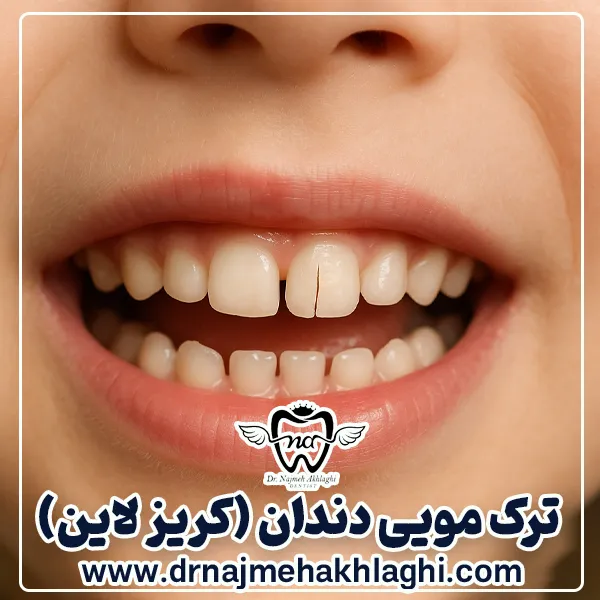 ترک مویی دندان