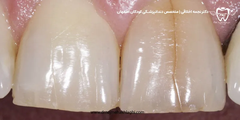 ترک مویی دندان