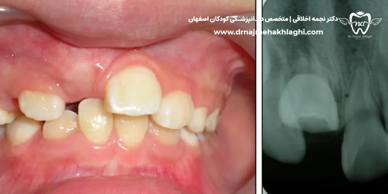 نهفتگی دندان کودک
