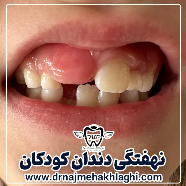 نهفتگی دندان کودک