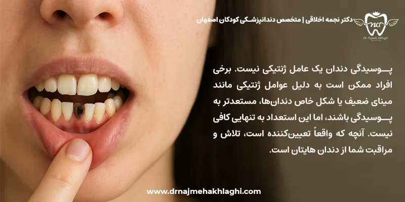 آیا پوسیدگی دندان ارثی است؟