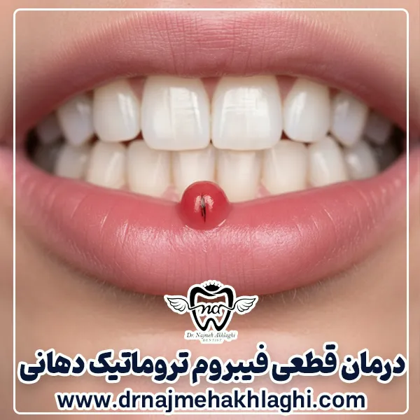 فیبروم تروماتیک دهانی