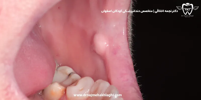 فیبروم دهان چیست؟