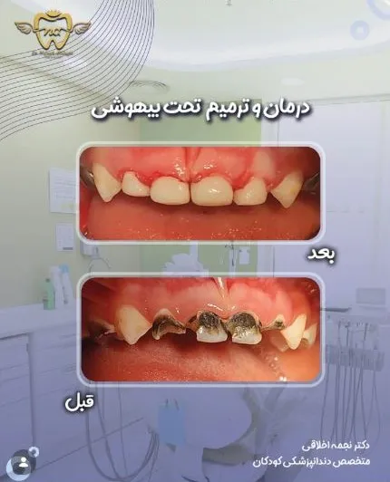 نمونه کیس‌های درمان دکتر اخلاقی متخصص دندانپزشکی کودکان بیهوشی