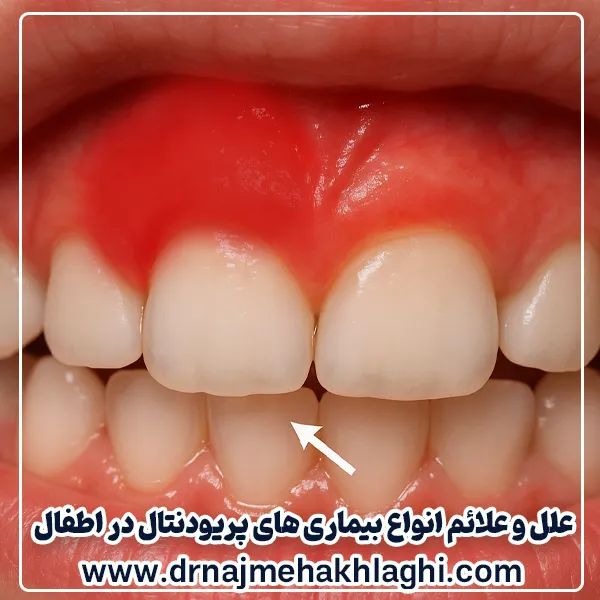 بیماری های پریودنتال در اطفال