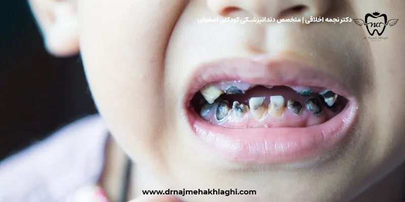 پیشگیری و درمان سندرم شیشه شیر