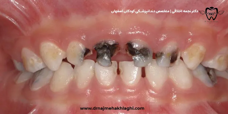 پیشگیری و درمان سندرم شیشه شیر