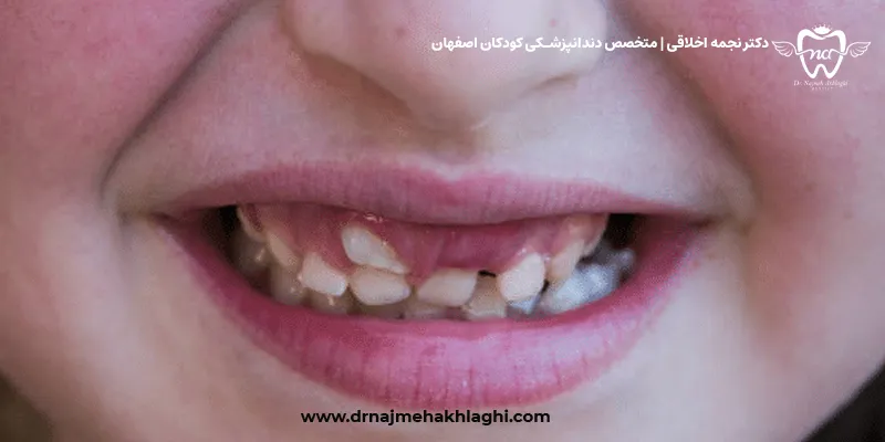 دندان کوسه ای در کودکان