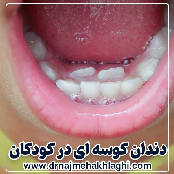 دندان کوسه ای در کودکان