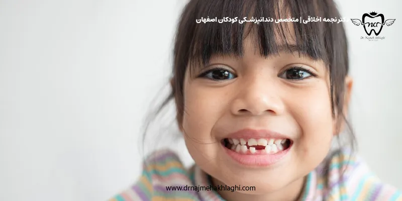 بهترین جایگزین دندان شیری کشیده شده