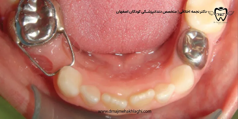 بهترین جایگزین دندان شیری کشیده شده