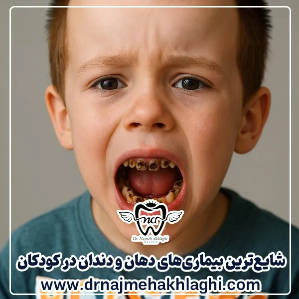 شایع ترین بیماری دهان و دندان در کودکان
