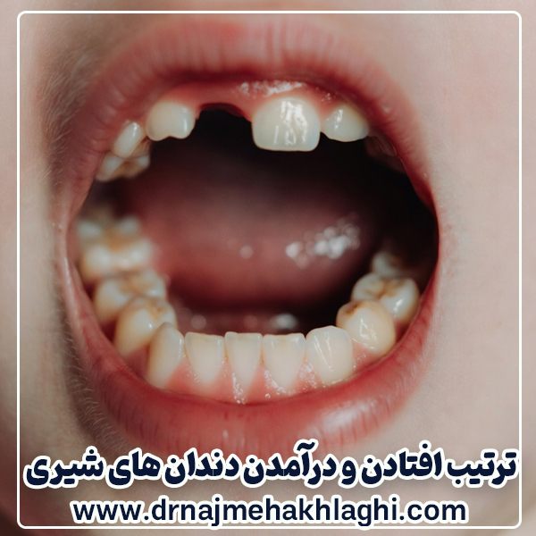 ترتیب افتادن و درآمدن دندان های شیری