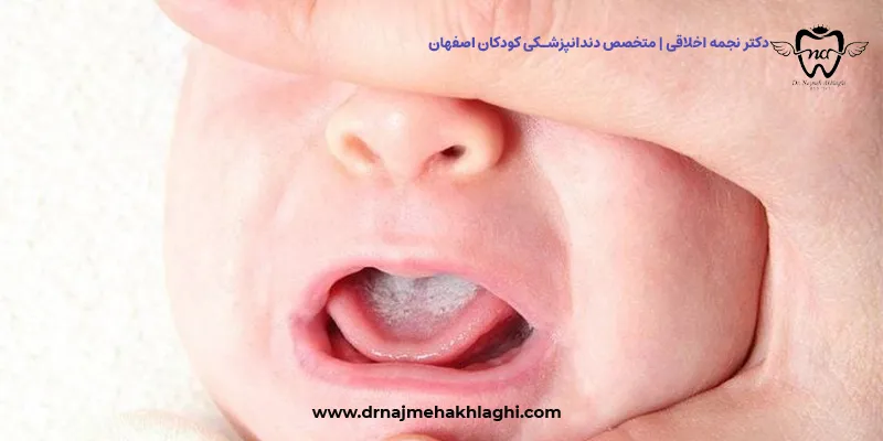 برفک دهان در کودکان