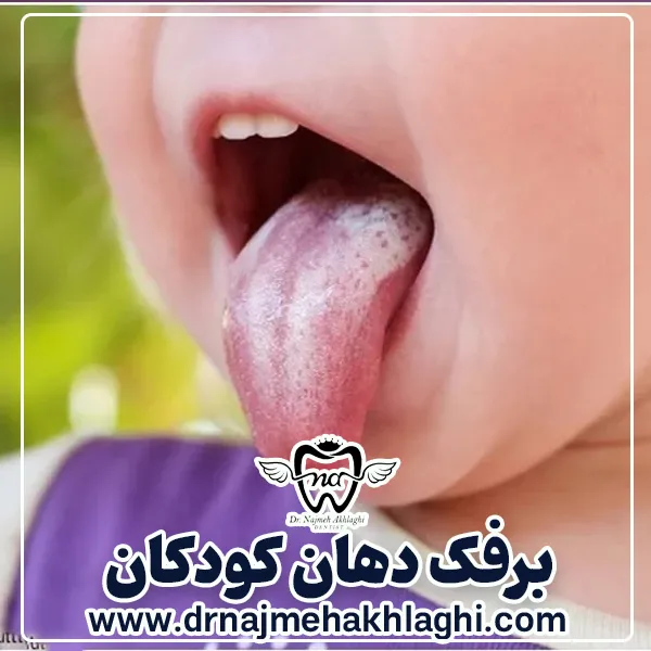 برفک دهان در کودکان