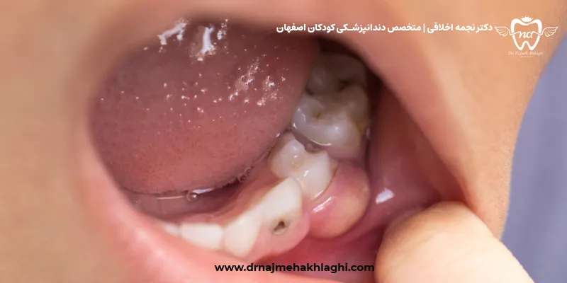 آبسه دندان